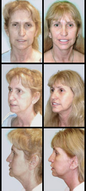 Imágenes de Antes y Después del Levantamiento Facial (Lifting)