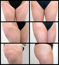 Imágenes de Antes y Después de la Liposucción.