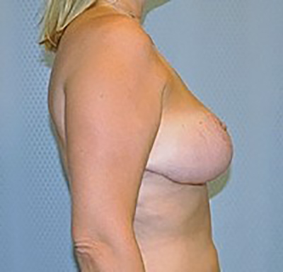 breast-reduction-plastic-surgery-upland-woman-after-side-dr-maan-kattash