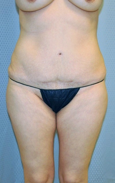 buttock-augmentation-brazilian-butt-lift-los-angeles-woman-before-front-dr-maan-kattash