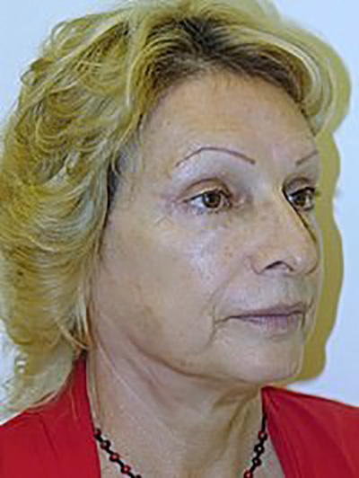 facelift-plastic-surgery-los-angeles-woman-after-oblique-dr-maan-kattash