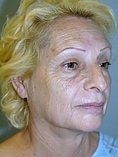 facelift-plastic-surgery-los-angeles-woman-before-oblique-dr-maan-kattash