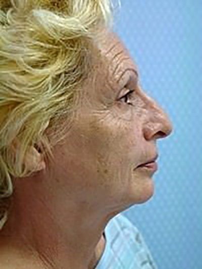 facelift-plastic-surgery-los-angeles-woman-before-side-dr-maan-kattash