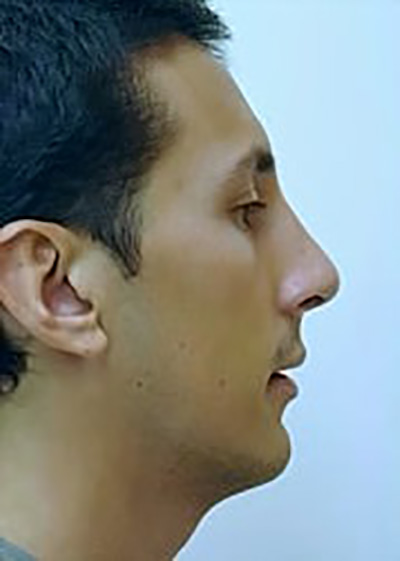 rhinoplasty-plastic-surgery-nose-job-inland-empire-man-after-oblique-dr-maan-kattash2