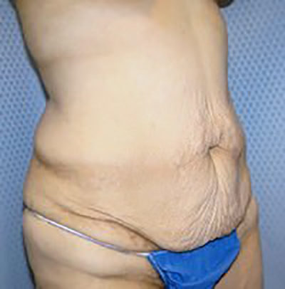 tummy-tuck-plastic-surgery-abdominoplasty-loose-skin-ontario-woman-before-oblique-dr-maan-kattash