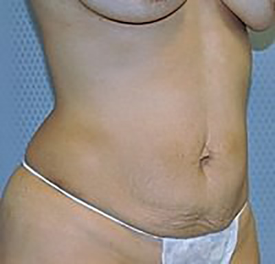 tummy-tuck-plastic-surgery-abdominoplasty-loose-skin-rancho-cucamonga-woman-before-oblique-dr-maan-kattash