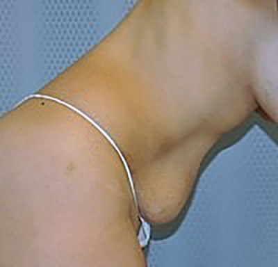 tummy-tuck-plastic-surgery-abdominoplasty-loose-skin-rancho-cucamonga-woman-before-side-dr-maan-kattash