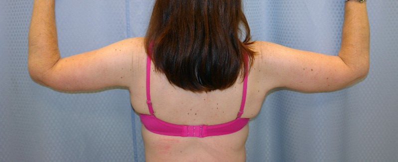 brachioplasty-arm-lift-beverly-hills-woman-after-back-dr-maan-kattash