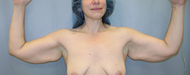 brachioplasty-arm-lift-beverly-hills-woman-before-front-dr-maan-kattash