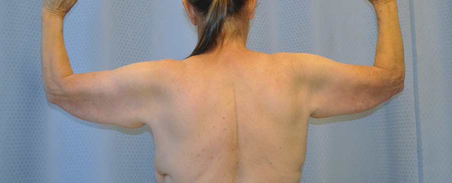 brachioplasty-arm-lift-sagging-arm-skin-beverly-hills-woman-before-back-dr-maan-kattash