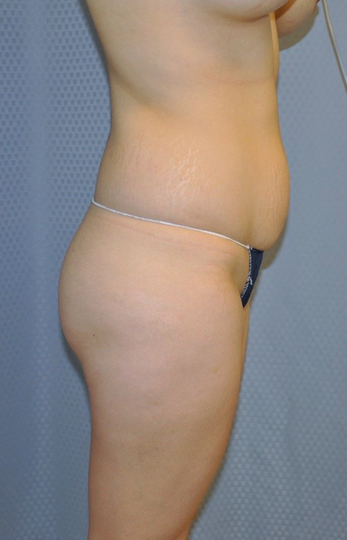 Buttock Augmentation Before and After Pictures