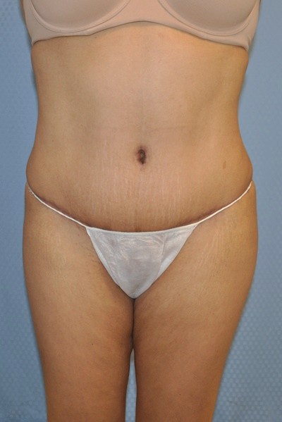 brazilian-butt-lift-plastic-cosmetic-surgery-inland-empire-woman-after-front-dr-maan-kattash