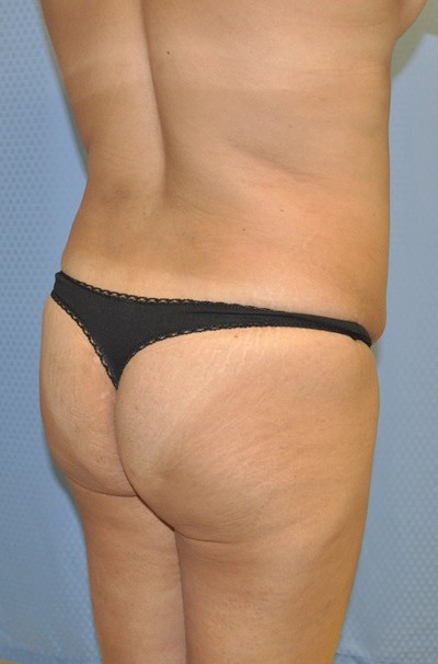 brazilian-butt-lift-plastic-cosmetic-surgery-inland-empire-woman-before-back-dr-maan-kattash