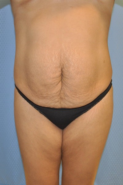 brazilian-butt-lift-plastic-cosmetic-surgery-inland-empire-woman-before-front-dr-maan-kattash