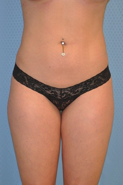 brazilian-butt-lift-plastic-surgery-irvine-woman-cosmetic-after-front-dr-maan-kattash