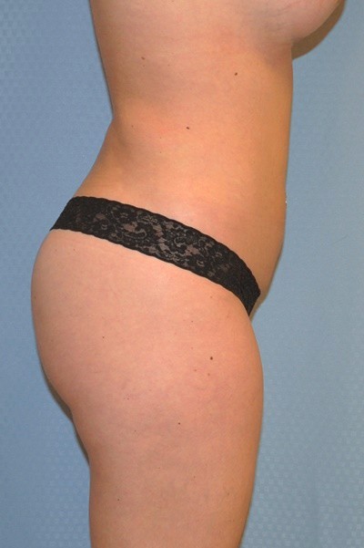 brazilian-butt-lift-plastic-surgery-irvine-woman-cosmetic-after-side-dr-maan-kattash