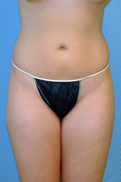 brazilian-butt-lift-plastic-surgery-irvine-woman-cosmetic-before-front-dr-maan-kattash