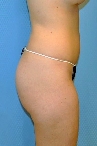 brazilian-butt-lift-plastic-surgery-irvine-woman-cosmetic-before-side-dr-maan-kattash