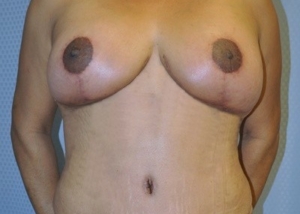 breast-lift-reduction-plastic-surgery-rancho-cucamonga-woman-front-after-surgeon-dr-maan-kattash