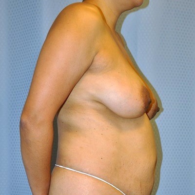 breast-lift-vertical-mastopexy-plastic-surgery-beverly-hills-woman-before-side-dr-maan-kattash