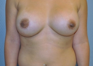 breast-revision-capsular-contracture-surgery-rancho-cucamonga-woman-after-front-dr-maan-kattash
