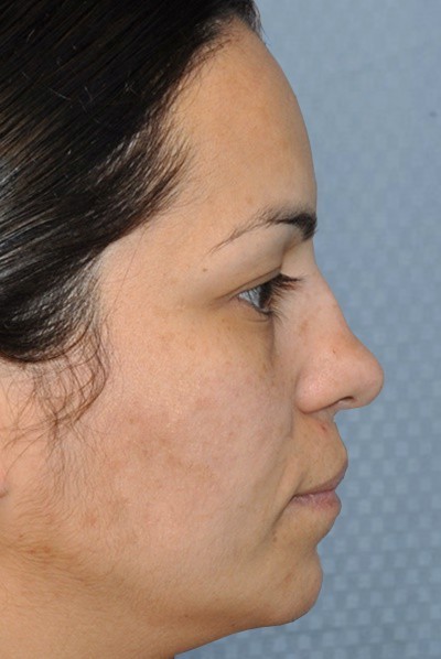 rhinoplasty-plastic-surgery-nose-job-beverly-hills-woman-before-side-dr-maan-kattash