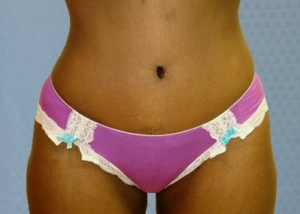tummy-tuck-abdominoplasty-brazilian-butt-transfer-orange-county-woman-after-front-dr-maan-kattash