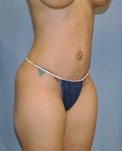 tummy-tuck-abdominoplasty-hernia-repair-surgery-los-angeles-inland-empire-woman-after-oblique-dr-maan-kattash