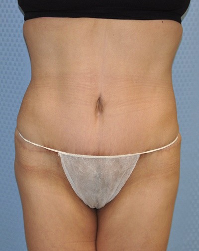 tummy-tuck-abdominoplasty-plastic-surgery-rancho-cucamonga-inland-empire-woman-after-front-dr-maan-kattash