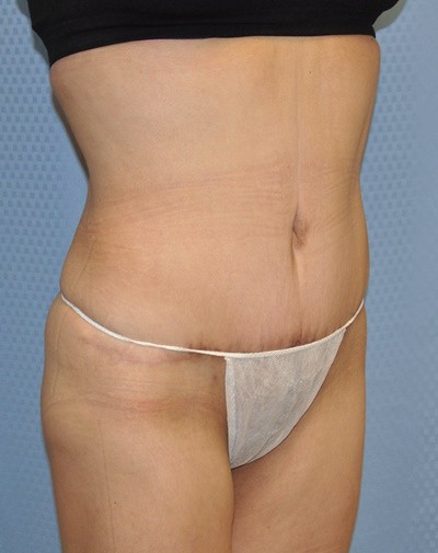 tummy-tuck-abdominoplasty-plastic-surgery-rancho-cucamonga-inland-empire-woman-after-oblique-dr-maan-kattash