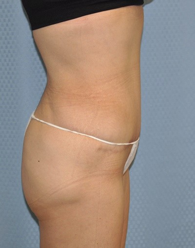 tummy-tuck-abdominoplasty-plastic-surgery-rancho-cucamonga-inland-empire-woman-after-side-dr-maan-kattash