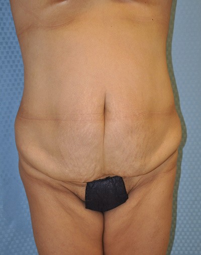 tummy-tuck-abdominoplasty-plastic-surgery-rancho-cucamonga-inland-empire-woman-before-front-dr-maan-kattash