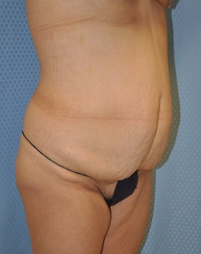 tummy-tuck-abdominoplasty-plastic-surgery-rancho-cucamonga-inland-empire-woman-before-oblique-dr-maan-kattash