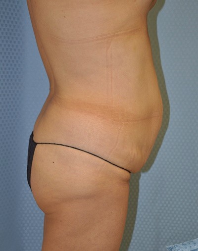 tummy-tuck-abdominoplasty-plastic-surgery-rancho-cucamonga-inland-empire-woman-before-side-dr-maan-kattash