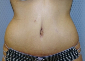 tummy-tuck-abdominoplasty-surgery-rancho-cucamonga-inland-empire-woman-after-front-dr-maan-kattash