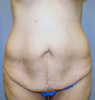 tummy-tuck-abdominoplasty-surgery-rancho-cucamonga-inland-empire-woman-before-front-dr-maan-kattash