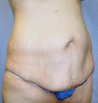 tummy-tuck-abdominoplasty-surgery-rancho-cucamonga-inland-empire-woman-before-oblique-dr-maan-kattash