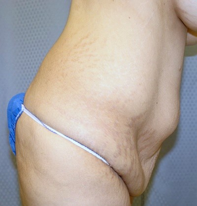 tummy-tuck-abdominoplasty-surgery-rancho-cucamonga-inland-empire-woman-before-side-dr-maan-kattash