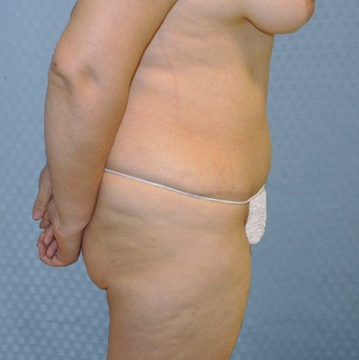 tummy-tuck-revision-abdominoplasty-plastic-surgery-rancho-cucamonga-woman-before-side-dr-maan-kattash