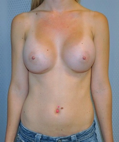 breast-enlargement-augmentation-plastic-surgery-beverly-hills-woman-after-front-dr-maan-kattash