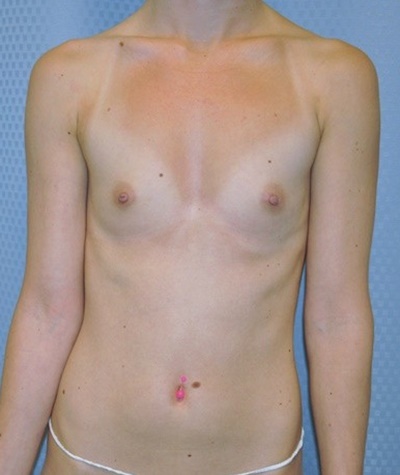 breast-enlargement-augmentation-plastic-surgery-beverly-hills-woman-before-front-dr-maan-kattash