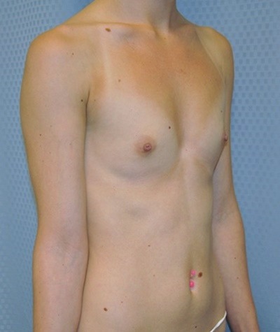 breast-enlargement-augmentation-plastic-surgery-beverly-hills-woman-before-oblique-dr-maan-kattash