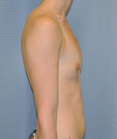 breast-enlargement-augmentation-plastic-surgery-beverly-hills-woman-before-side-dr-maan-kattash