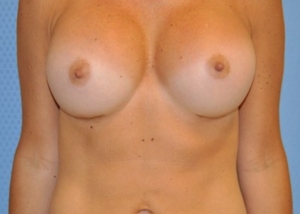 breast-enlargement-augmentation-plastic-surgery-claremont-woman-after-front-dr-maan-kattash