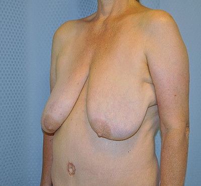 breast-lift-plastic-surgery-irvine-upland-woman-before-left-ob-dr-maan-kattash