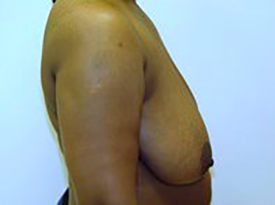 breast-lift-plastic-surgery-mastopexy-beverly-hills-woman-before-side-dr-maan-kattash