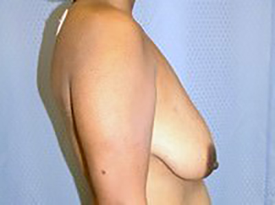 breast-lift-plastic-surgery-mastopexy-los-angeles-woman-before-side-dr-maan-kattash