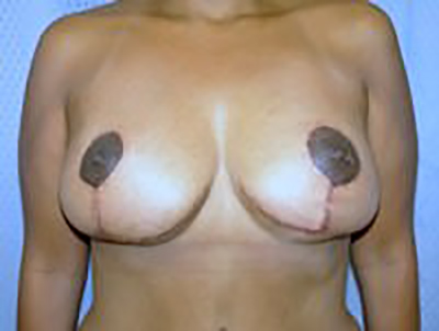breast-lift-plastic-surgery-mastopexy-los-angeles-woman-woman-after-dr-maan-kattash