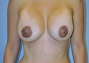 breast-revision-rancho-cucamonga-woman-after-front-dr-maan-kattash