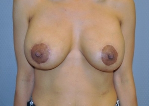 breast-revision-surgery-augmentation-claremont-woman-after-front-dr-maan-kattash